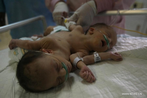 Conjoined twins lie on a bed at a hospital in the West Bank city of Hebron on June 3, 2013. The twins were born with one heart and two bodies connected. (Xinhua/Mamoun Wazwaz)