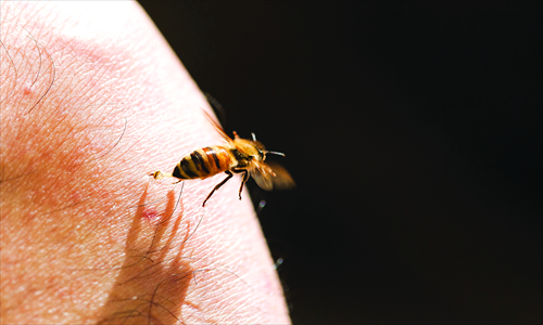 A bee thrusts its stinger into a patient. Bees are used to treat diseases like arthritis.Photo:IC