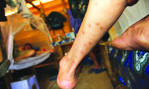 A worker resting on his bed shows a leg full of mosquito bites on October 31. Photo: IC