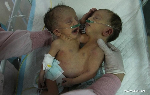 Conjoined twins lie on a bed at a hospital in the West Bank city of Hebron on June 3, 2013. The twins were born with one heart and two bodies connected. (Xinhua/Mamoun Wazwaz)