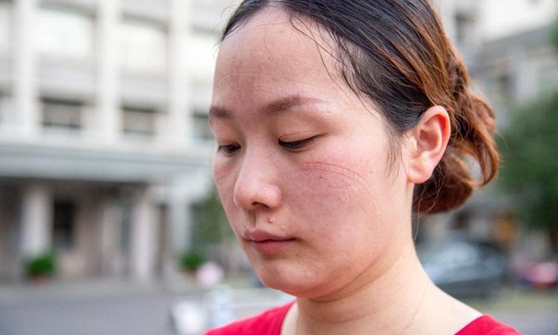 Mask marks are seen on the face of nurse Zhang Xianghan in Wuhan, central China's Hubei Province, Aug. 6, 2021. To promptly contain the latest COVID-19 resurgence, central China's Wuhan collected over 10.3 million samples for nucleic acid testing in three days, local authorities said Friday.Photo:Xinhua