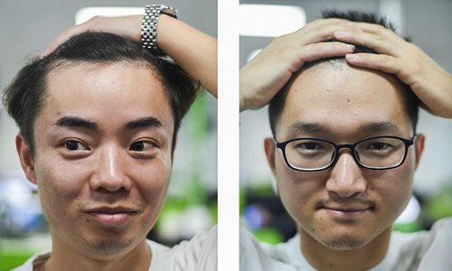 An internet company in Hangzhou, East China's Zhejiang province, holds a unique hairline challenge in June. The prize is a hair transplant package worth more than 5,000 yuan ($700). Photo: VCG