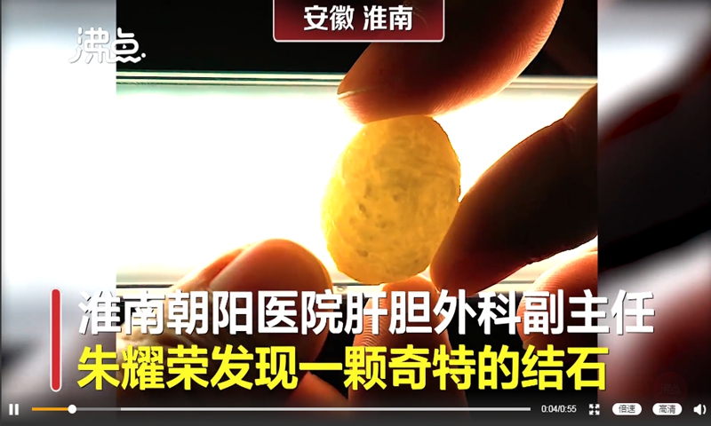 A doctor in Huainan, East China's Anhui Province was shocked to discover golden 'Buddhist relics' inside a patient's body during a gallbladder operation, which turned out later to be an unusual gallstone. Photo: screenshot of Feidian Video on Sina Weibo. 