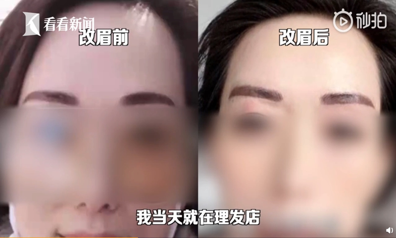 A woman in Hangzhou, East China's Zhejiang Province, recently underwent an expensive eyebrow tattoo surgery which, instead of bringing her good looks and good luck, ended up looking like two Chinese broadswords. Photo: screenshot of Kankan News on Sina Weibo. 
