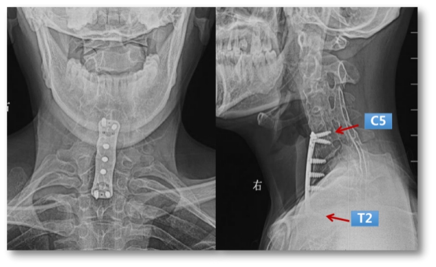 Preoperative X-ray: post-surgery ACCF, cervical multi vertebral fusion and kyphosis deformity
