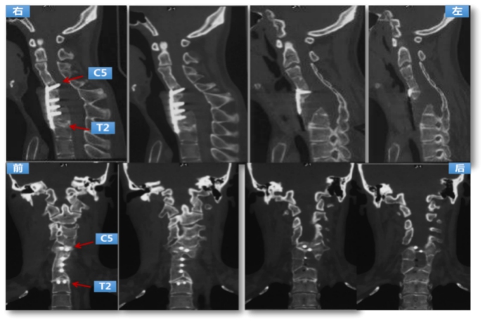 Preoperative CT: the left anterior bone defect of cervicothoracic vertebrae, partial screw’s original nail plate system was cut out before the spinal canal was entered. 