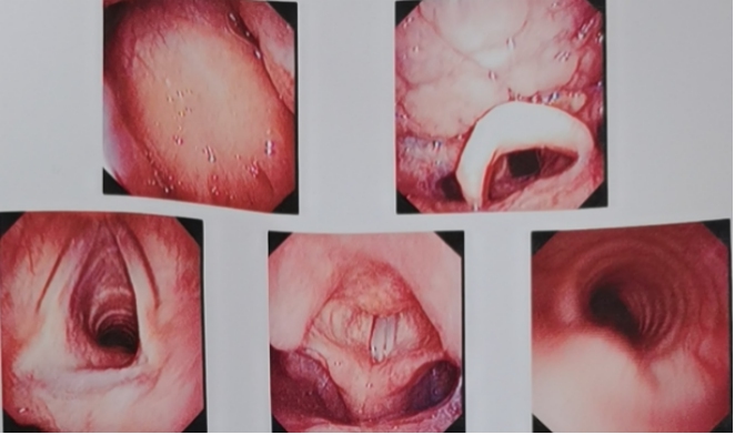 To evaluate the function of recurrent laryngeal nerve and vocal cord on the original side and determine the surgical approach. 