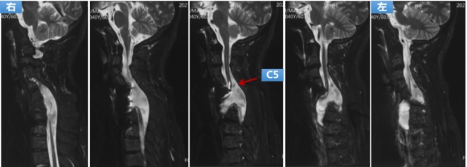 Preoperative MRI: the dura mater and spinal cord herniated from the defected bone to the front of the vertebral body to the left, which shows spinal cord compression and ischemic degeneration. 