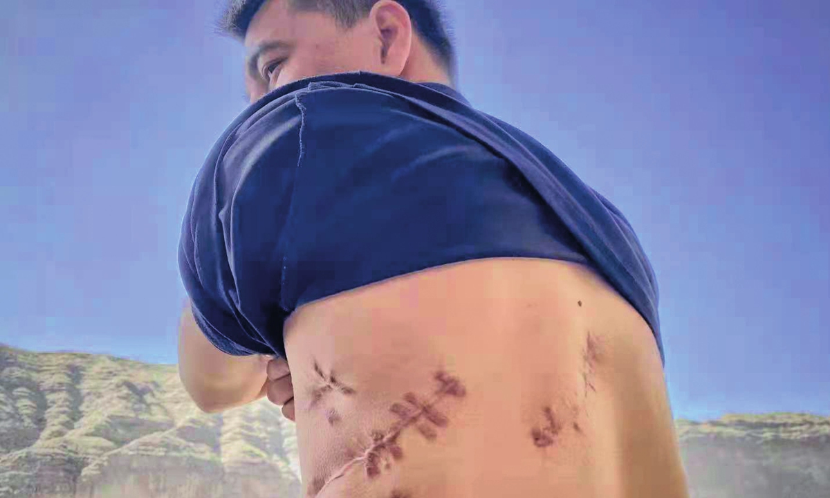 The picture shows scars by the gunshot on the back of Dilxat Photo: He Zhuoqian/GT