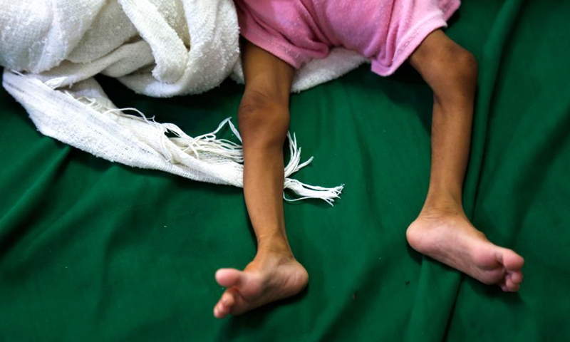 An acutely malnourished child lies on a bed in the al-Thawrah hospital in Hodeidah, the Red Sea port city of Yemen, Nov. 20, 2021.Photo:Xinhua