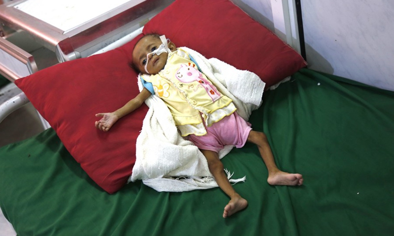 An acutely malnourished child lies on a bed in the al-Thawrah hospital in Hodeidah, the Red Sea port city of Yemen, Nov. 20, 2021.(Photo: Xinhua)