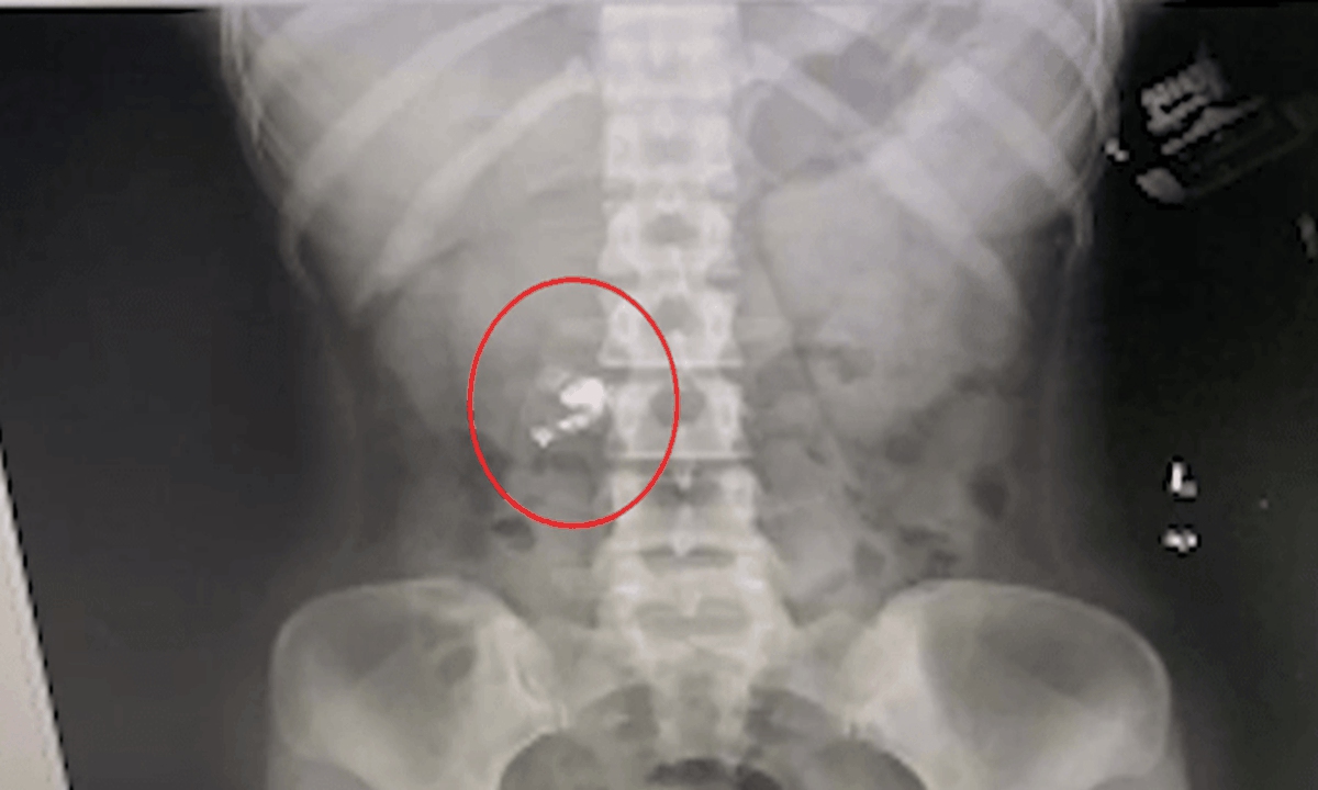 The X-ray of Miss Li, showing the Bluetooth earpiece she swallowed. Photo: Sohu.com