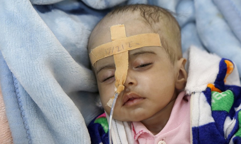 A Yemeni malnourished child lies on a bed as he receives medical treatment at the malnutrition treating ward in Al-Sabeen hospital in Sanaa, Yemen, on Feb. 21, 2022.(Photo: Xinhua)
