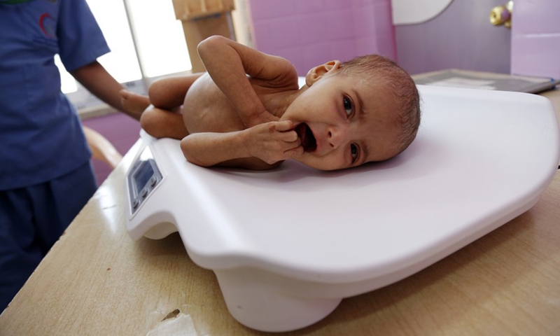 A health worker gets a malnourished child weighed as he receives medical treatment at the malnutrition treating ward in a hospital in Sanaa, Yemen, on March 13, 2022.(Photo: Xinhua)