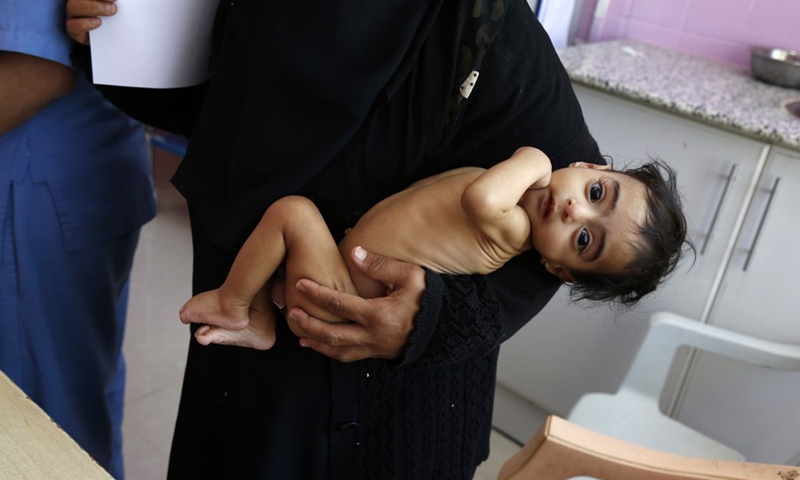 A mother holds her malnourished child in her arm when the child receives medical treatment at the malnutrition treating ward in a hospital in Sanaa, Yemen, on March 13, 2022.(Photo: Xinhua)