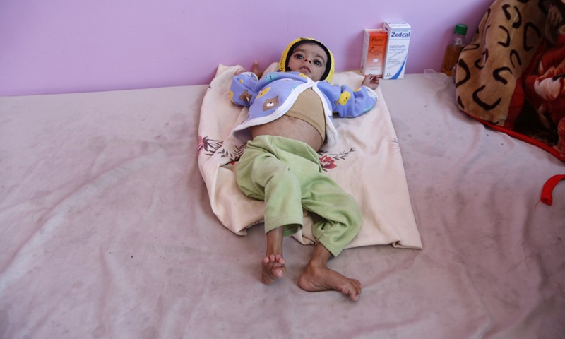 A malnourished child lies on a bed as he receives medical treatment at the malnutrition treating ward in a hospital in Sanaa, Yemen, on March 13, 2022.(Photo: Xinhua)