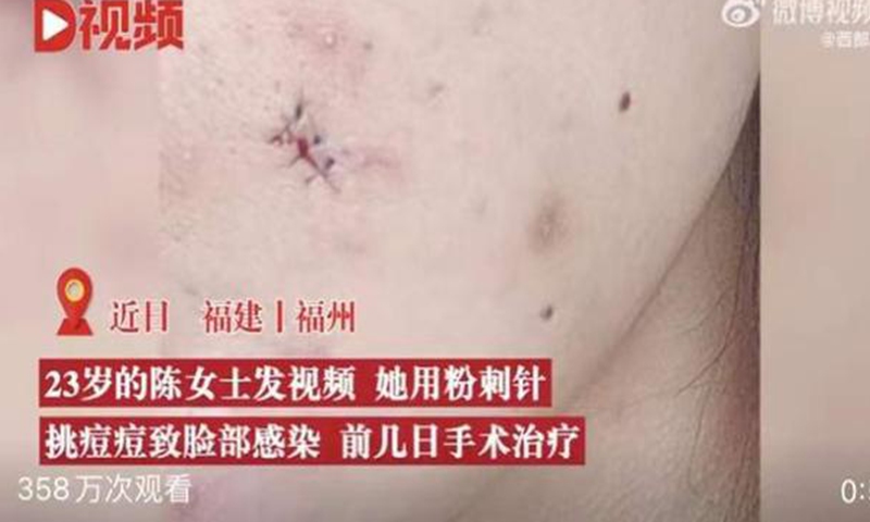 Young woman in Fujian gets six stitches for face infection after popping a pimple. Screenshot of D Video