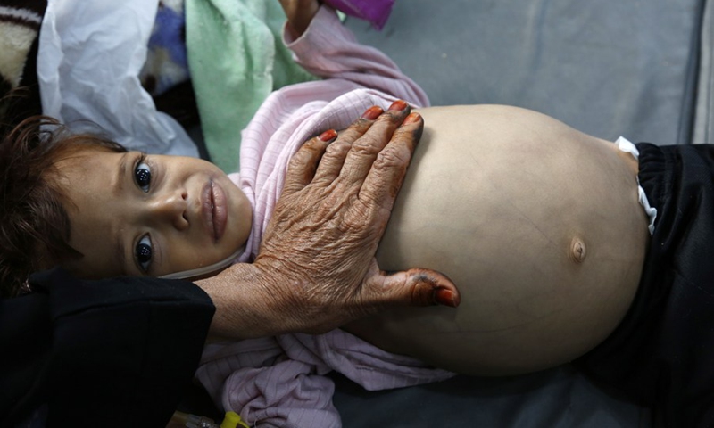 A malnourished child lies on the bed, waiting for the doctor to treat her, at the malnutrition treatment department of a hospital in Sanaa, Yemen, on July 16, 2022.(Photo: Xinhua)