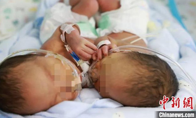 A pair of one-month-old conjoined twins were successfully separated in Hangzhou, East China's Zhejiang Province recently.Screenshot of Chinanews.com