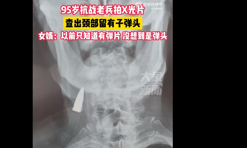 A 95-year-old veteran from Linyi, East China's Shandong Province, found a bullet in his neck during a physical examination on Friday.Screenshot of Shandong Radio and Television