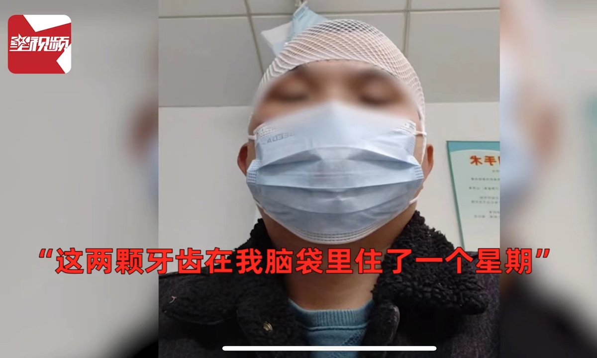 A man in Dongguan, South China's Guangdong Province, found two of his rival's teeth stuck on his head six days after both of them were injured in a basketball competition.Photo: Star Video