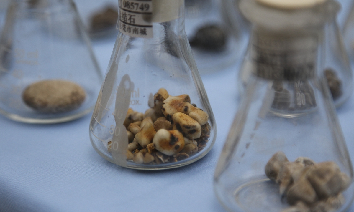 Gallstones Photo: VCG