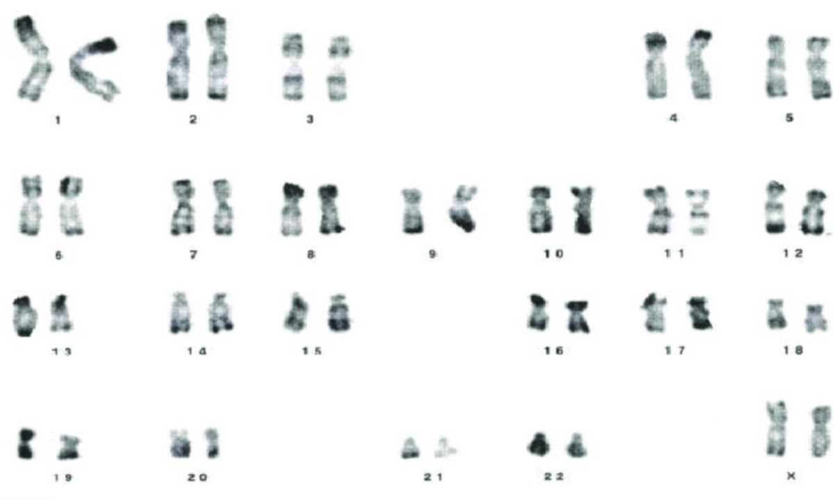 46 XX Male Syndrome. Photo: web