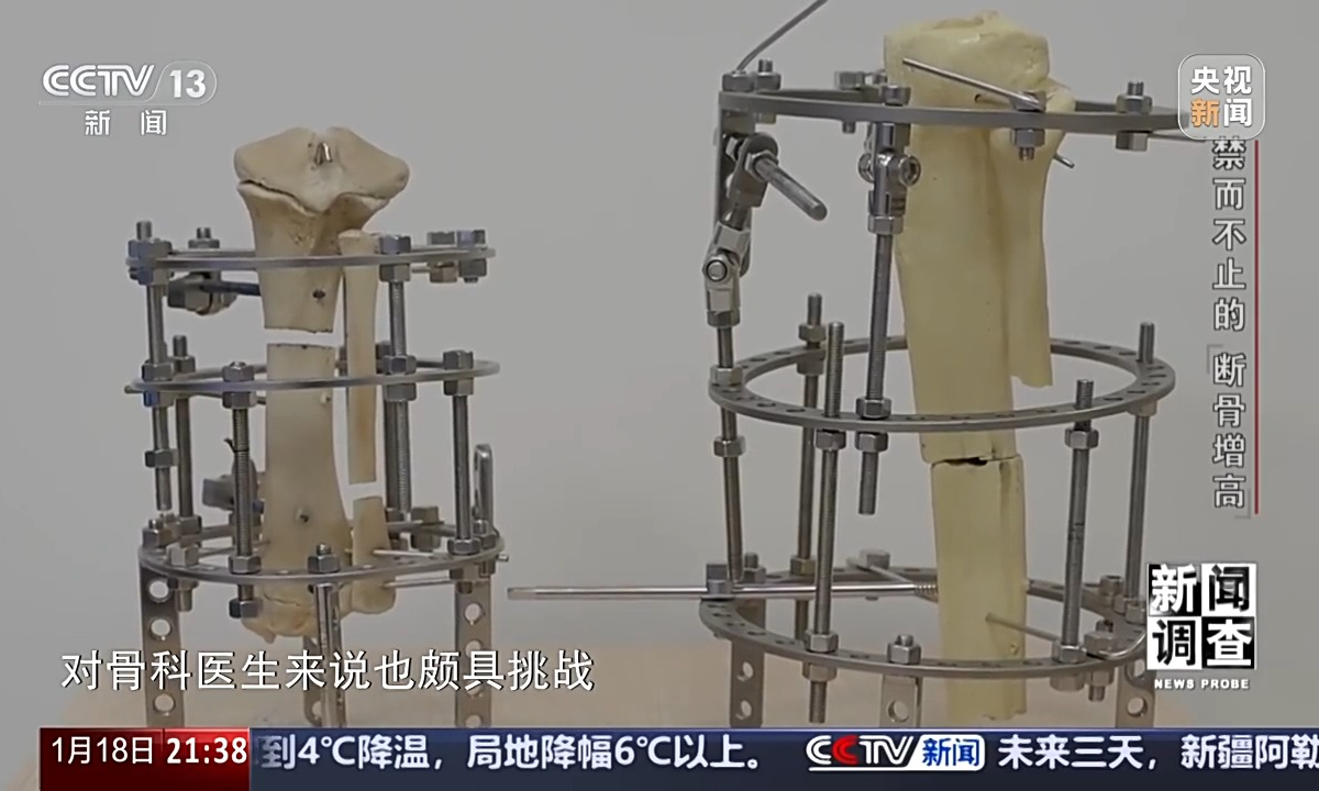 Limb lengthening surgery originally serves the purpose of treating congenital deformities, shortened limbs due to acquired causes, bone defects and other diseases. Photo: CCTV News
