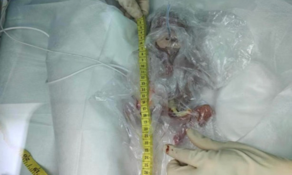 Newborn Ruirui measured only 20 cm at birth. Photo: Screenshot from media report 