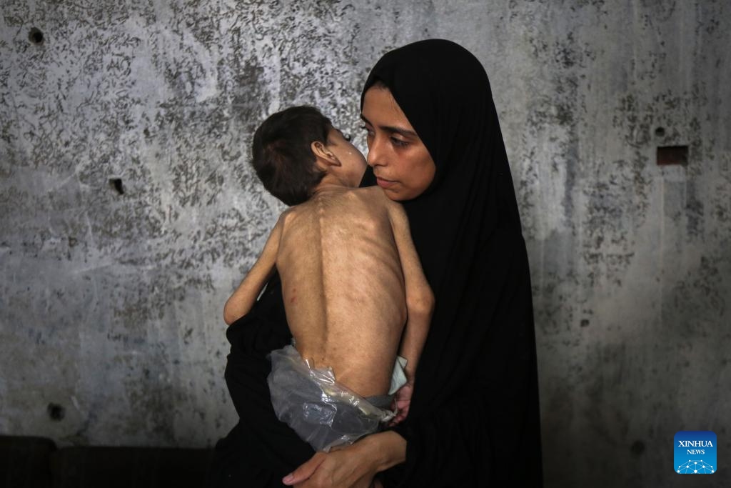 A displaced Palestinian child who suffers from malnutrition and cerebral palsy is seen inside a school-turned shelter in the northwest of Gaza City, July 25, 2025. (Photo by Rizek Abdeljawad/Xinhua)