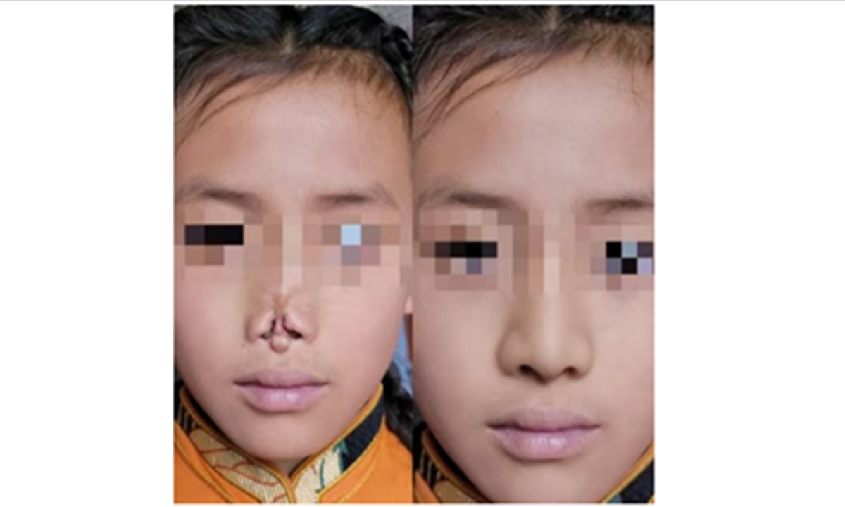 Image showing Drglma' s reconstructed nose Photo: screenshot from the Wechat account of the Shaanxi Media Convergence