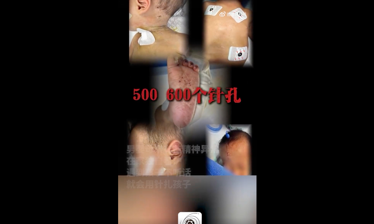 Infant boy in Southwest China’s Yunnan Province found with needle marks on his body after mother allegedly applied folk “needle therapy” Photo: Sina Weibo
