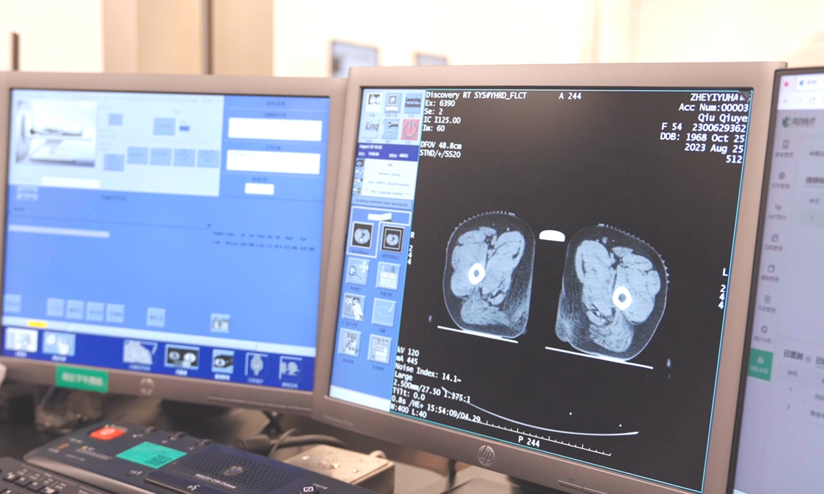 An AI model analyzes CT imaging at the Second Hospital of Jiaxing in Zhejiang Province. Photo: Screenshot from a video provided by DAMO Academy
