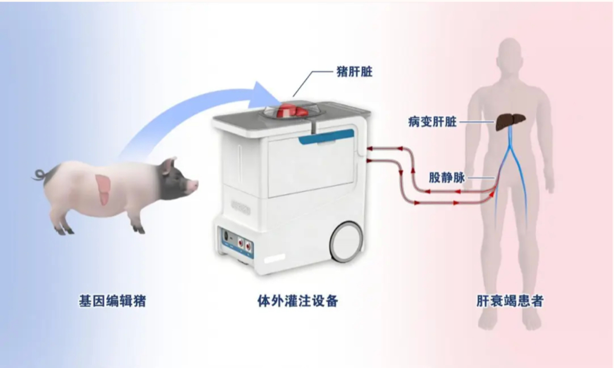 Illustration of the treatment of a liver failure patient using ex vivo perfusion with a six-gene-edited pig liver Photo: Screenshot from the WeChat account of Xijing Hospital