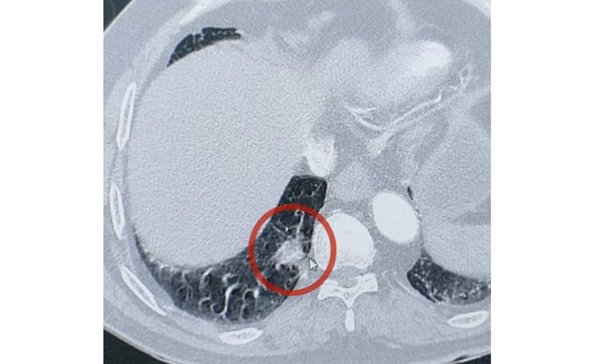 A CT scan image shows a suspected lung cancer nodule that later turned out to be a chili tip lodged in the lung. Photo: Screenshot from the official WeChat account of Xi'an International Medical Center Hospital