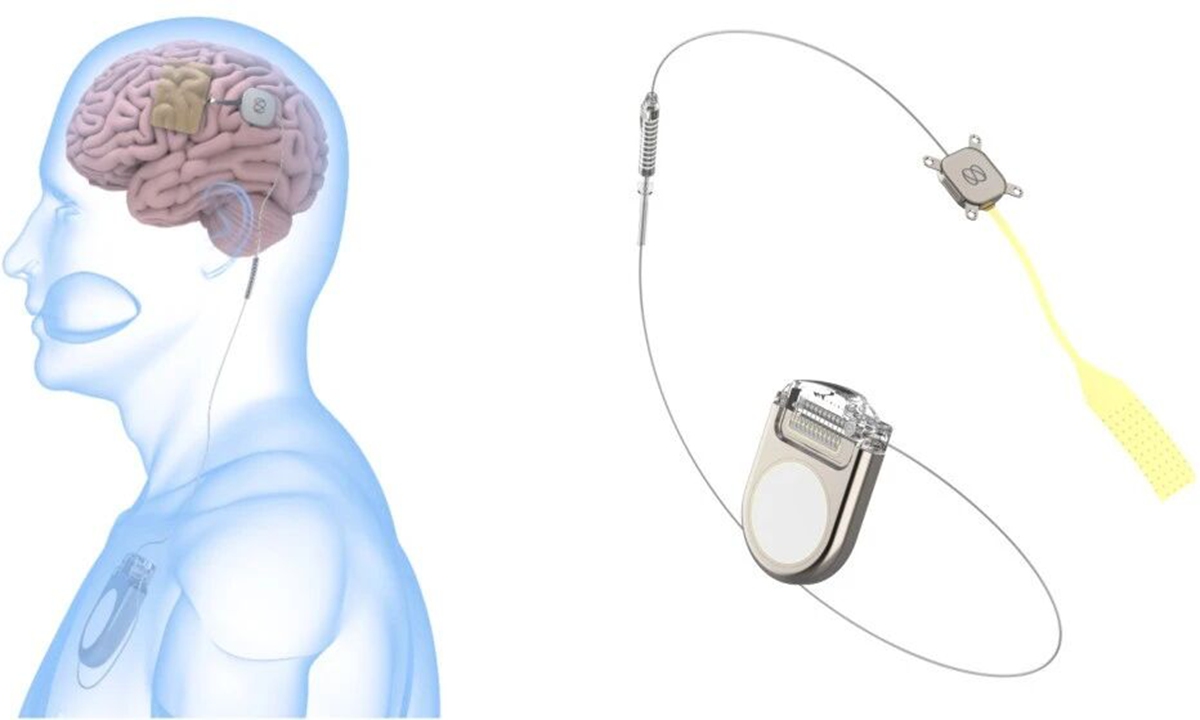NeuroXess' fully implantable brain-computer interface (BCI) system Photo: Screenshot of NeuroXess' WeChat post