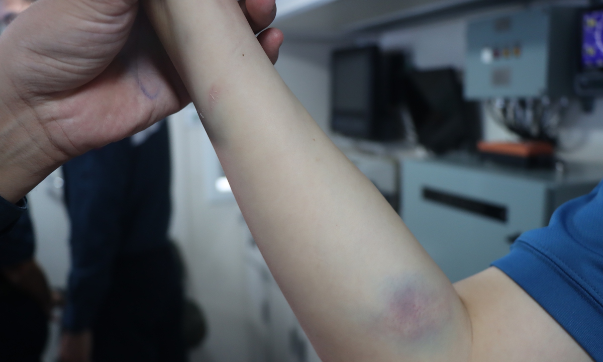 One Chinese law enforcement officer was injured during the malicious assault launched by the Philippine side in the waters near China's Ren'ai Jiao on July 20, 2026. Photo: CCG