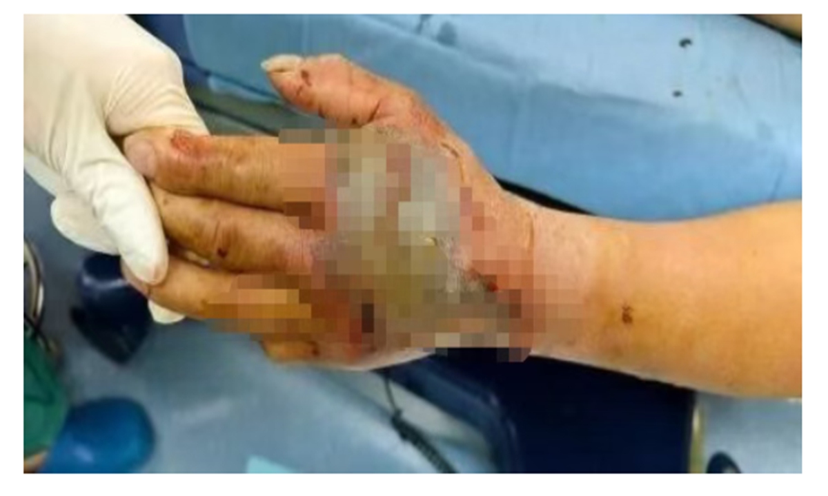 Zhang's hand bitten by the snake Photo: Screenshot from media reports