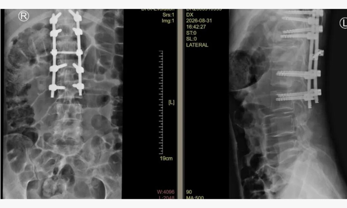 Postoperative digital X-ray image of Patient 1. Photo: Shenzhen Pingshan Hospital of Southern Medical University