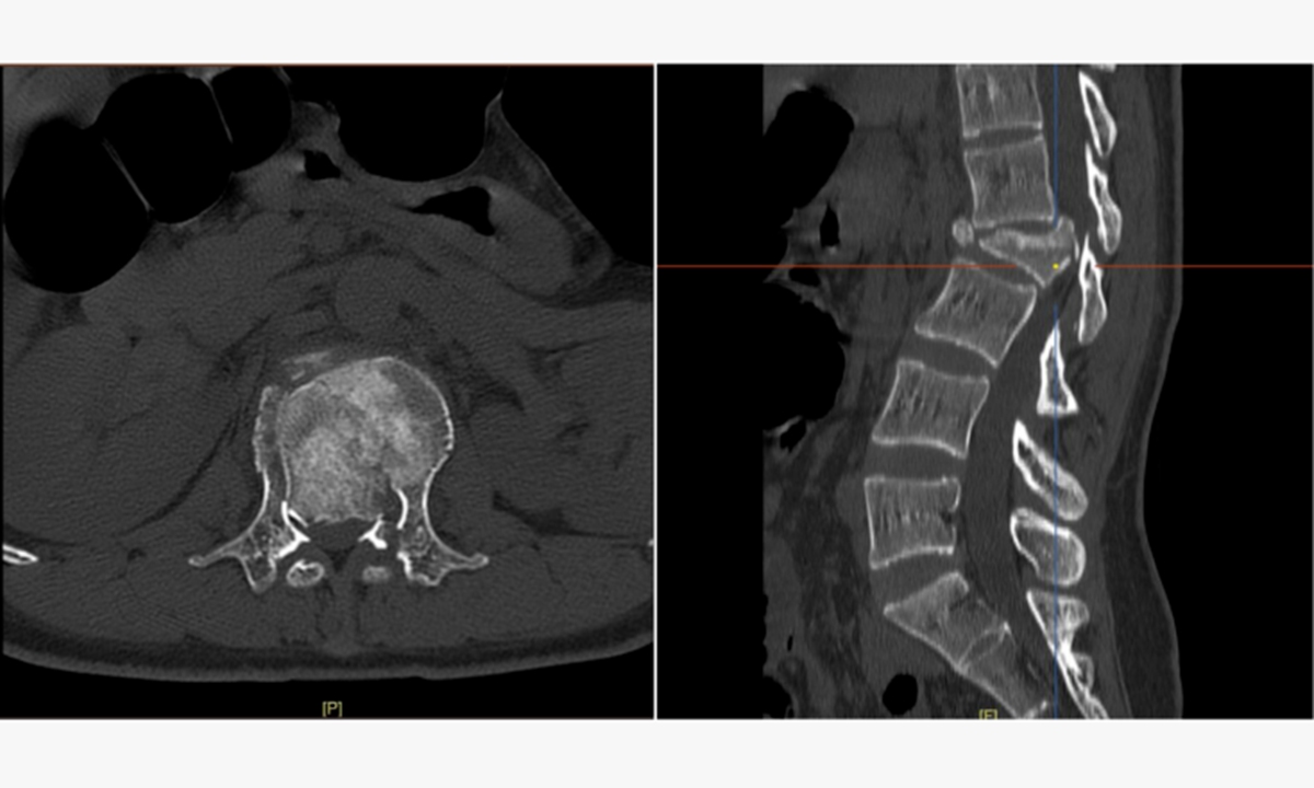 Preoperative CT scan of Patient 2. Photo: Shenzhen Pingshan Hospital of Southern Medical University