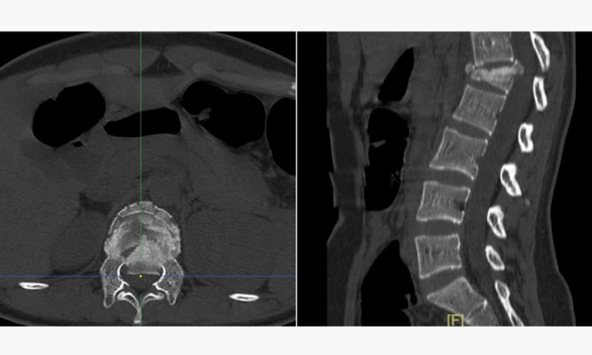 Preoperative CT scan of Patient 1. Photo: Shenzhen Pingshan Hospital of Southern Medical University